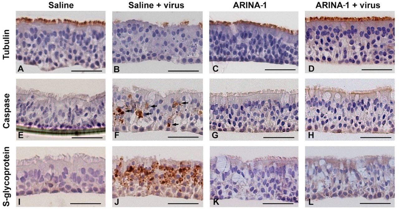 Histopathology studies showed that ARINA-1 protects primary HBE cells from SARS-CoV-2-mediated cytopathology. A-L) Representative photo micrographs of HBEC cross-sections with the immunohistochemistry and treatments. Each row corresponds to the immunohistochemistry using the antibody against the cell marker shown at the left, and each column corresponds to the treatment shown above the upper pictures. SARS-CoV-2 caused cilia shortening and loss in saline-treated cells (panel B). However, ARINA-1 protected cilia from damage (panel D). Similarly, the virus induced significant apoptosis in the mock-treated HBE cells (panel F, apoptotic cells indicated with arrows), which was not observed in those treated with ARINA-1 (panel H). In addition, mock-treated cells showed significant immunostaining using an antibody against the viral S glycoprotein (panel J), which again was not observed in the ARINA-1 treated cells (panel L). Scale bars represent 100 µm. Fully differentiated primary HBEC from two donors were used for the histopathology study. N β 10 pictures per donor and condition were taken and analyzed.