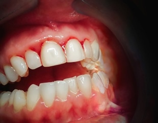 Understanding the relationship between SARS-CoV-2 infection and periodontitis