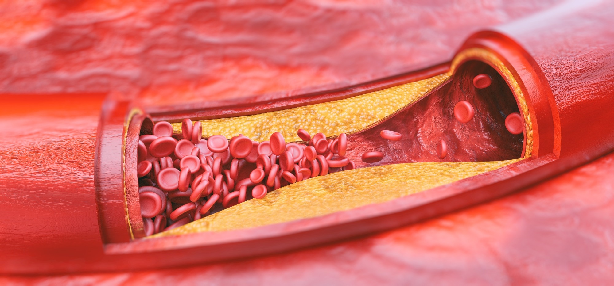 Study: Race-Dependent Association of High-Density Lipoprotein Cholesterol Levels With Incident Coronary Artery Disease. Image Credit: Crevis/Shutterstock