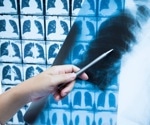 Post-COVID-19 CT scans show lung abnormalities persist two years later