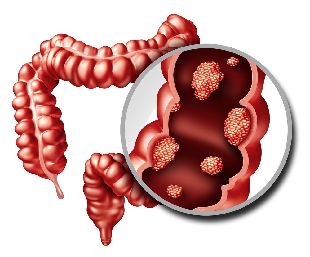 Study: Can butyrate prevent colon cancer? The AusFAP study: A randomised, crossover clinical trial. Image Credit: Lightspring / Shutterstock.com
