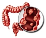A new trial to assess if butyrate can prevent colon cancer