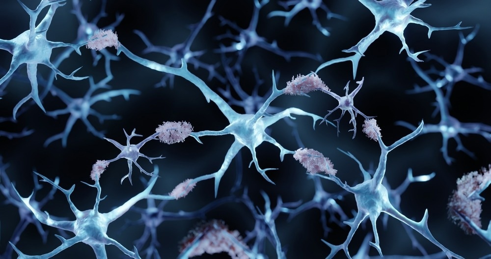 Study: Hallmarks of neurodegenerative diseases. Image Credit: ART-ur/Shutterstock
