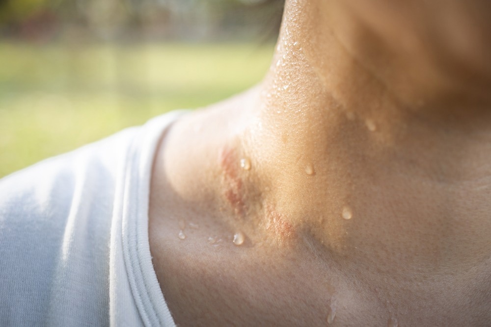 Study: Sweat as a diagnostic biofluid. Image Credit: CGN089/Shutterstock
