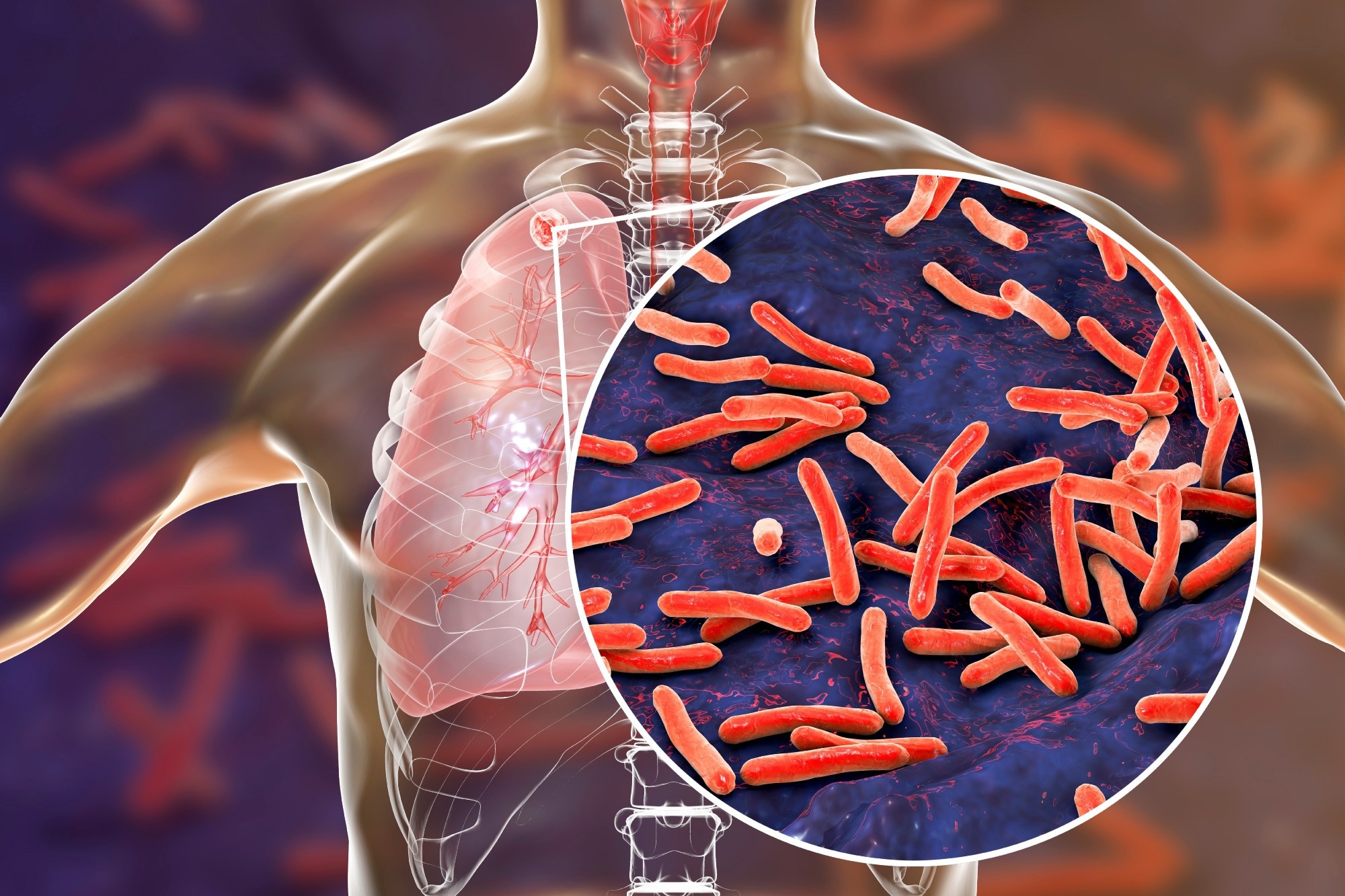 Study: Coping with drug resistant tuberculosis alongside COVID-19 and other stressors in Zimbabwe: a qualitative study. Image Credit: Kateryna Kon/Shutterstock