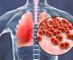 Serious pneumococcal infection increases the risk of a heart attack significantly