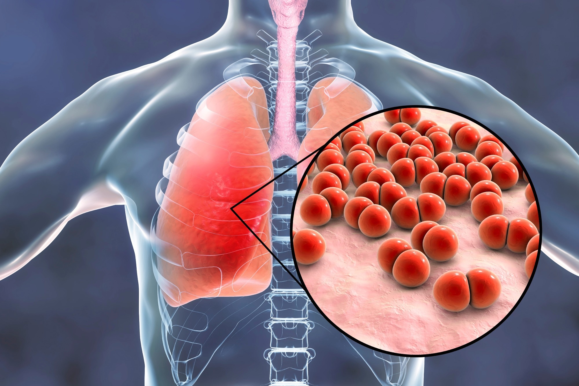 Study: Humans with inherited MyD88 and IRAK-4 deficiencies are predisposed to hypoxemic COVID-19 pneumonia. Image Credit: Kateryna Kon/Shutterstock