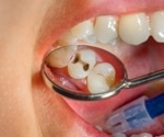 The development of the pediatric oral resistome and its role in dental caries