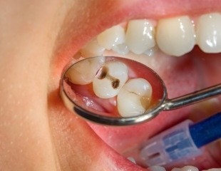 The development of the pediatric oral resistome and its role in dental caries