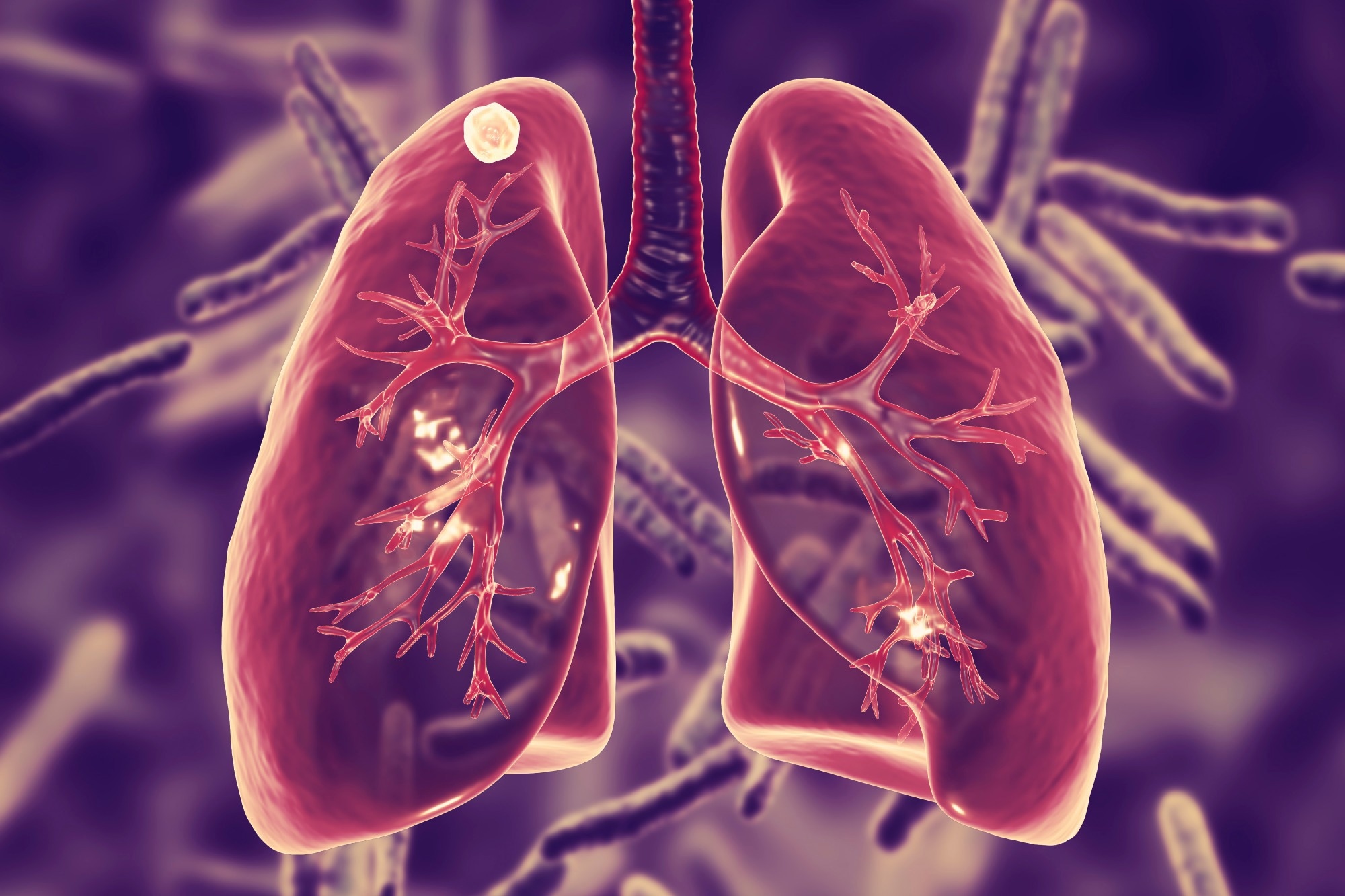 Morbidity and Mortality Weekly Report (MMWR) Tuberculosis — United States, 2022. Image Credit: Kateryna Kon / Shutterstock
