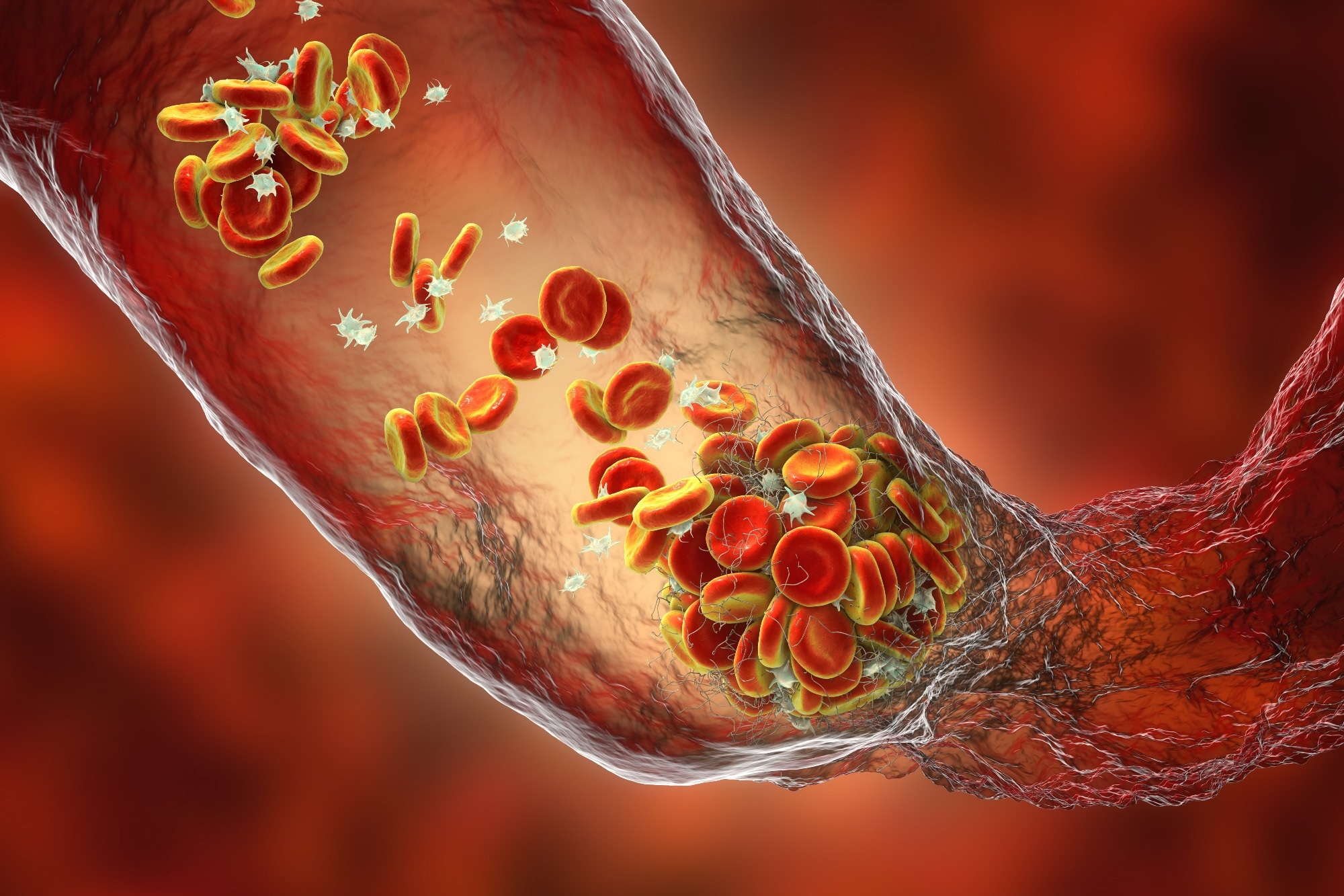 Study: Effect of Thromboprophylaxis on Clinical Outcomes After COVID-19 Hospitalization. Image Credit: Kateryna Kon / Shutterstock