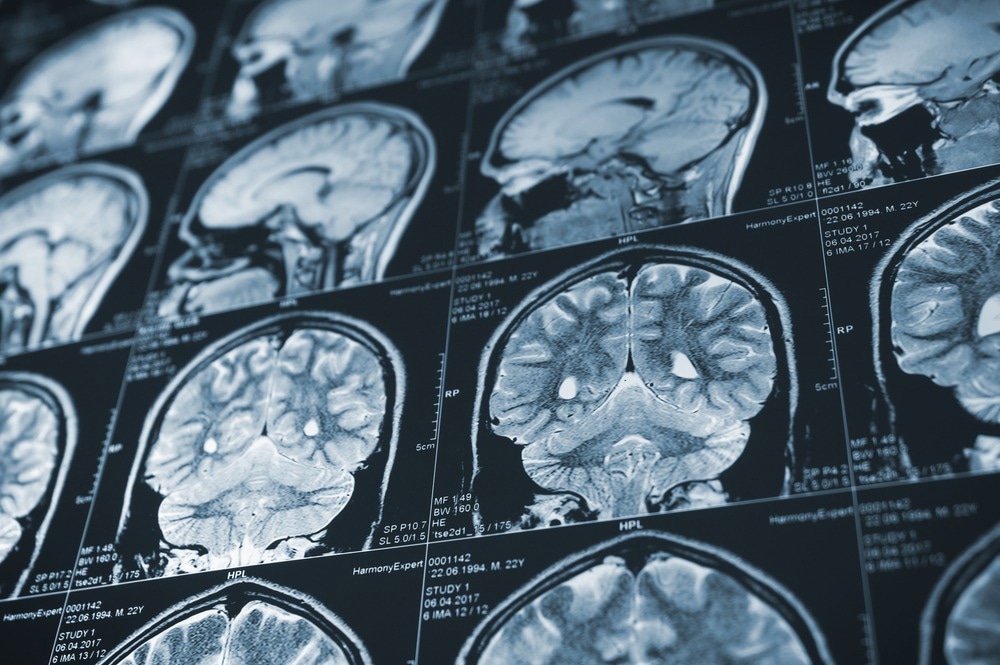 Study: Overlapping brain correlates of superior cognition among children at genetic risk for Alzheimer’s disease and/or major depressive disorder. Image Credit: SeanidStudio / Shutterstock.com