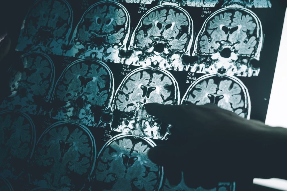 Study: Alzheimer’s disease: insights and new prospects in disease pathophysiology, biomarkers and disease-modifying drugs. Image Credit: Atthapon Raksthaput/Shutterstock