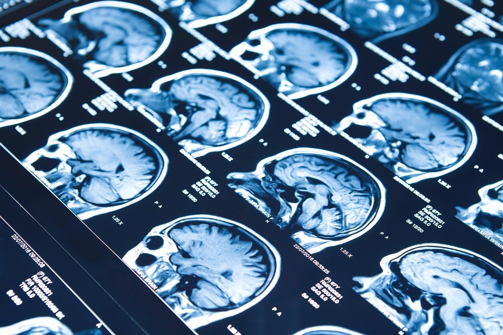 Study: Large-scale analysis of structural brain asymmetries in schizophrenia via the ENIGMA consortium. Image Credit: hutpaza / Shutterstock.com