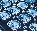 Study reveals subtle brain asymmetry differences in schizophrenia