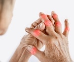 Study investigates vitamin C's effectiveness in treating gout and hyperuricemia