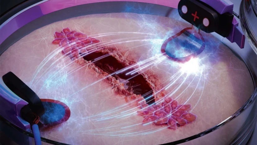 Using electric stimulation to make wounds heal three times faster