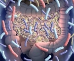 Parkinson's disease-like gut dysbiosis detected in early stages of the disease
