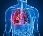 Every breath counts; Utilizing breath biopsy technology to detect disease early