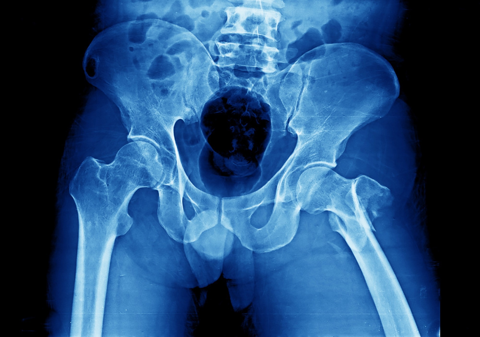 Bone breakthrough: Researchers develop ‘skeletal age’ tool to predict mortality risk after fractures