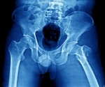 Bone breakthrough: Researchers develop 'skeletal age' tool to predict mortality risk after fractures
