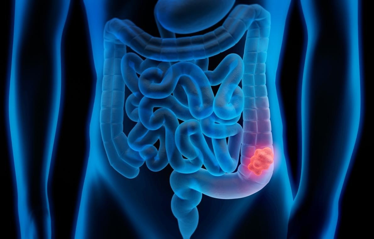 Double testing increases the accuracy of detecting bowel cancer