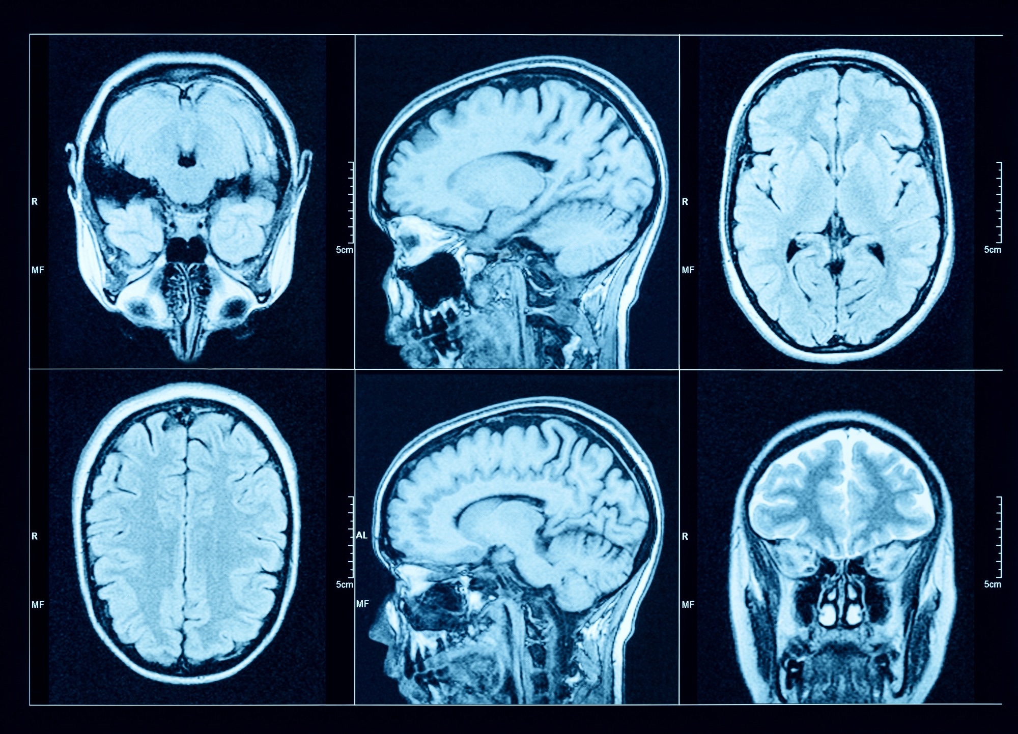Study: Association of gout with brain reserve and vulnerability to neurodegenerative disease. Image Credit: Triff / Shutterstock.com