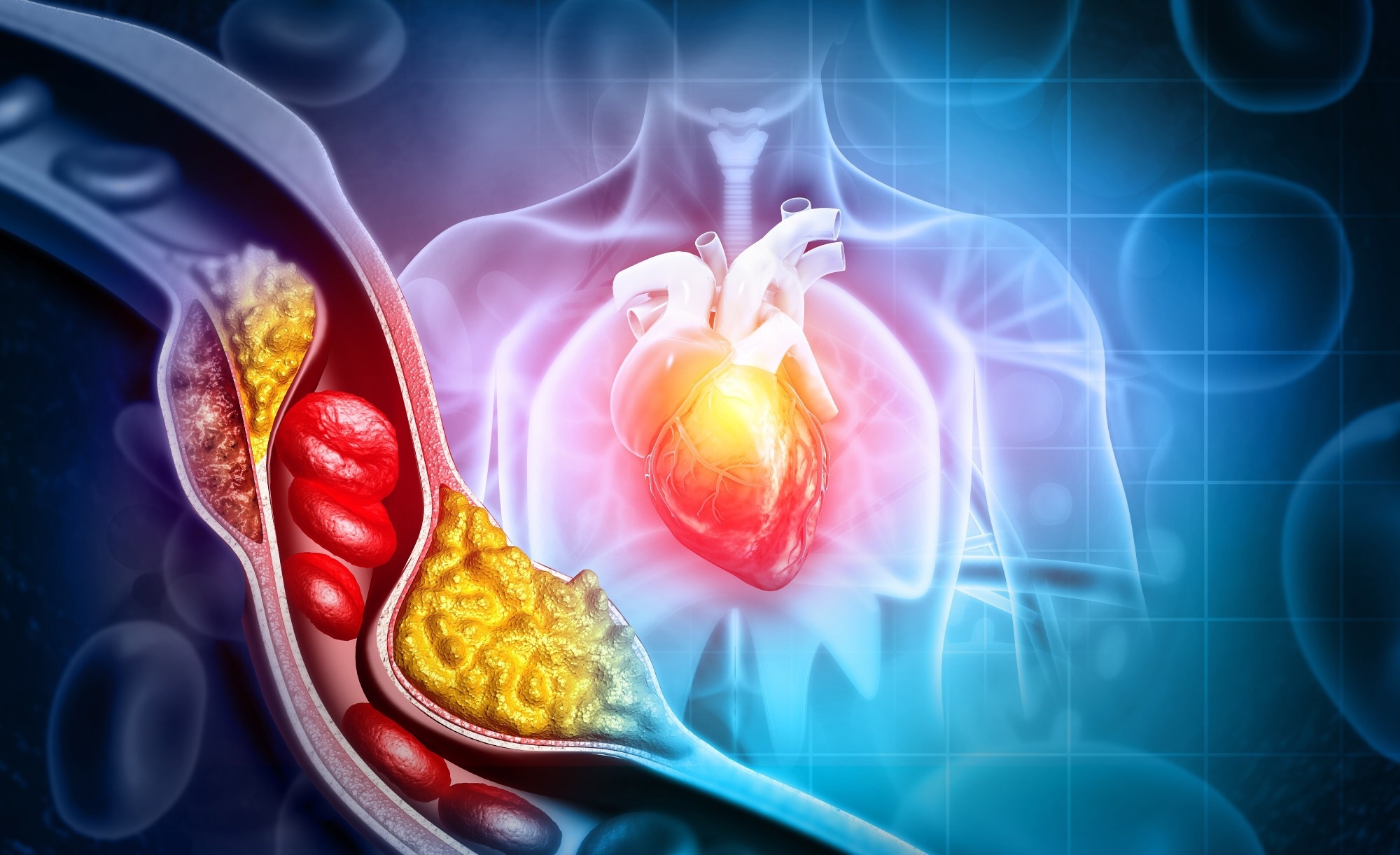 Study reveals type 2 diabetes diagnosis spurs cholesterol shifts, alters Ccardiovascular risk