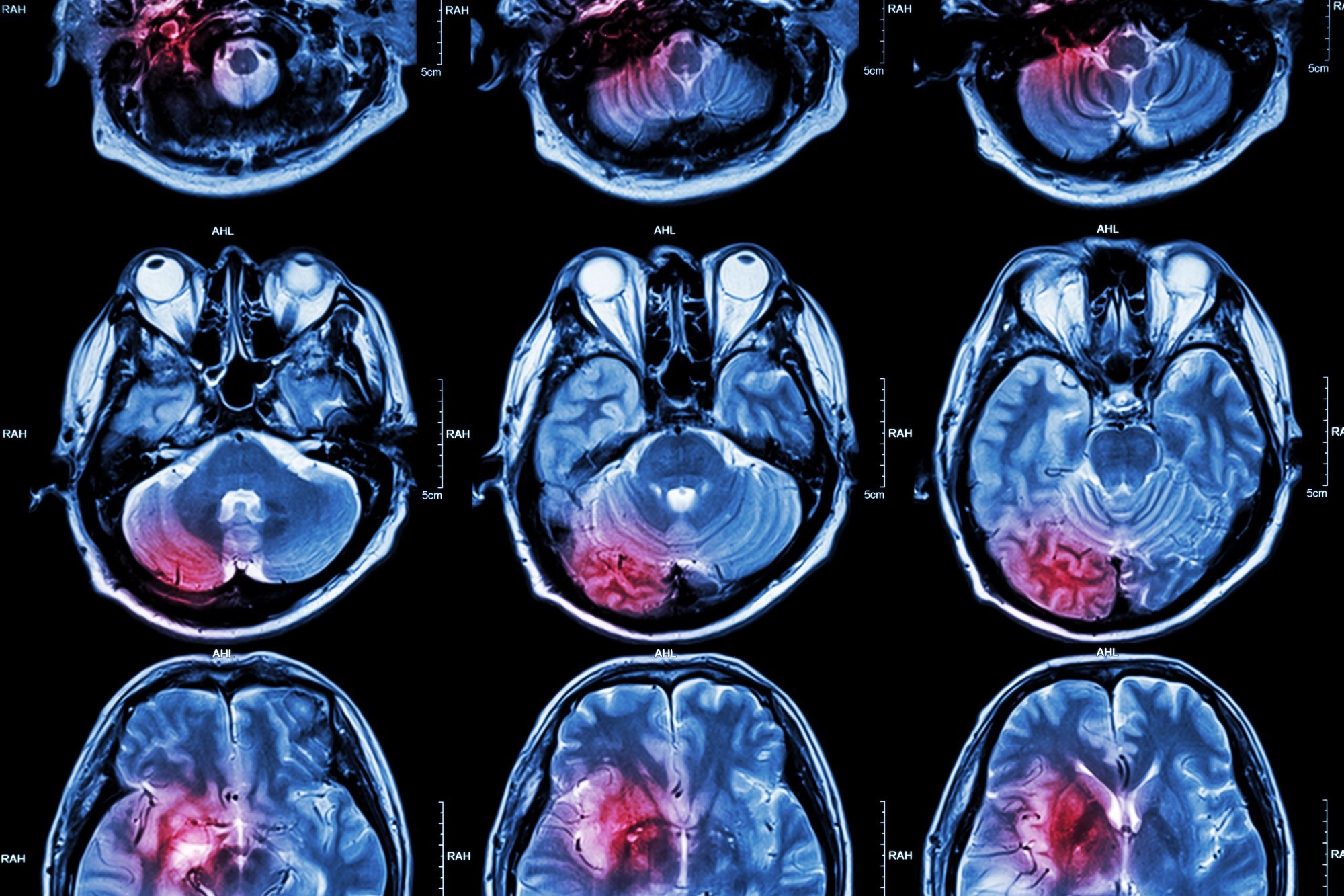 Study: The third Intensive Care Bundle with Blood Pressure Reduction in Acute Cerebral Haemorrhage Trial (INTERACT3): an international, stepped wedge cluster randomised controlled trial. Image Credit: PuwadolJaturawutthichai/Shutterstock.com