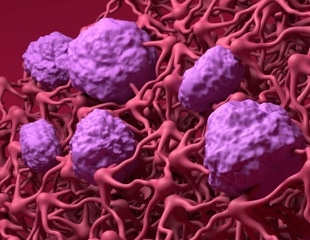 Multiple sclerosis: Immune cell invasion enabled by blood-brain barrier breakdown