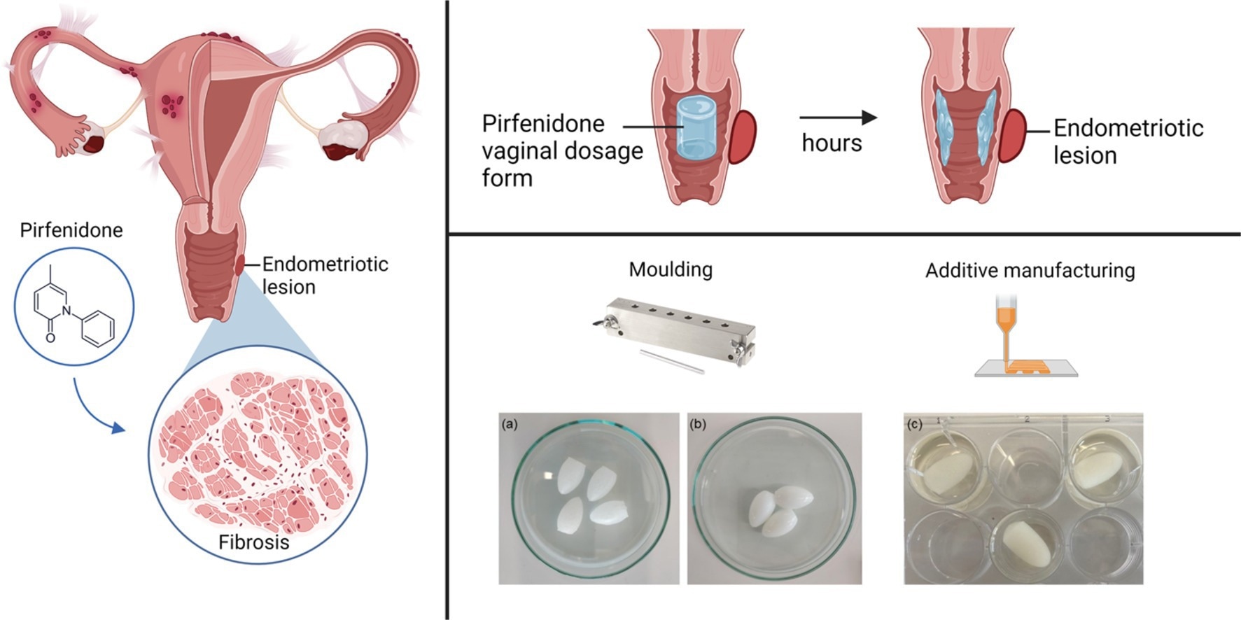 Study: Mucoadhesive 3D printed vaginal ovules to treat endometriosis and fibrotic uterine diseases.
