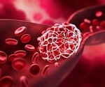 COVID-19 severity linked to autoantibodies against blood clotting protein