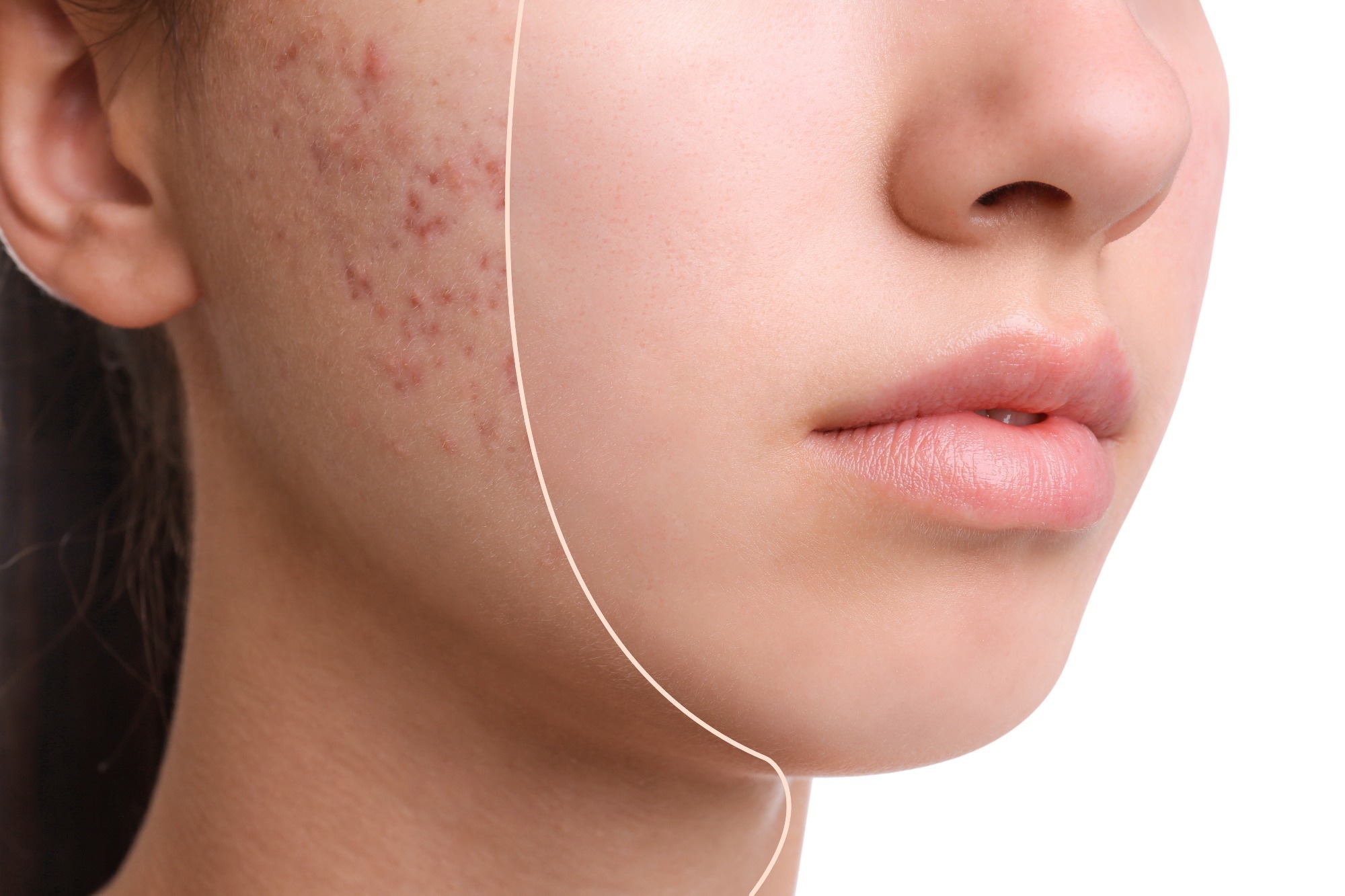 Distinctive plant extract combination has potent anti-acne results