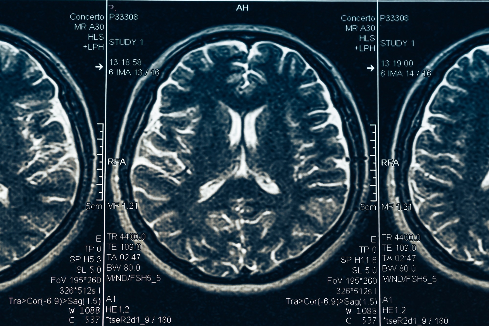 Study: Magnetic susceptibility is predictive of future clinical severity in Parkinson