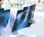 Study identifies potential immune biomarker for pulmonary tuberculosis: a step towards early detection