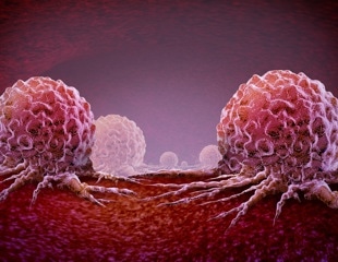 Copy number profiling provides insight as to why prostate cancer may become lethal