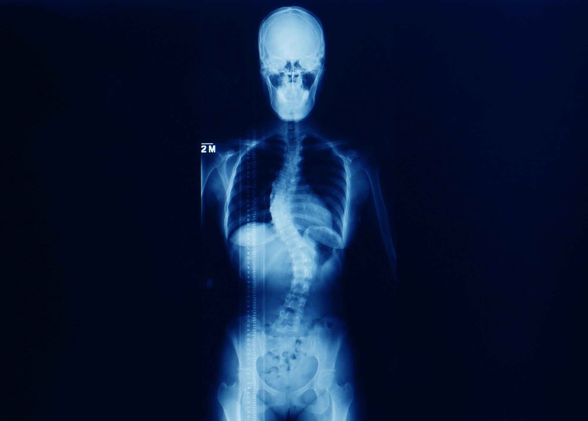 Study: Deep Learning Model to Classify and Monitor Idiopathic Scoliosis in Adolescents Using a Single Smartphone Photograph. Image Credit: Yok_onepiece/Shutterstock.com