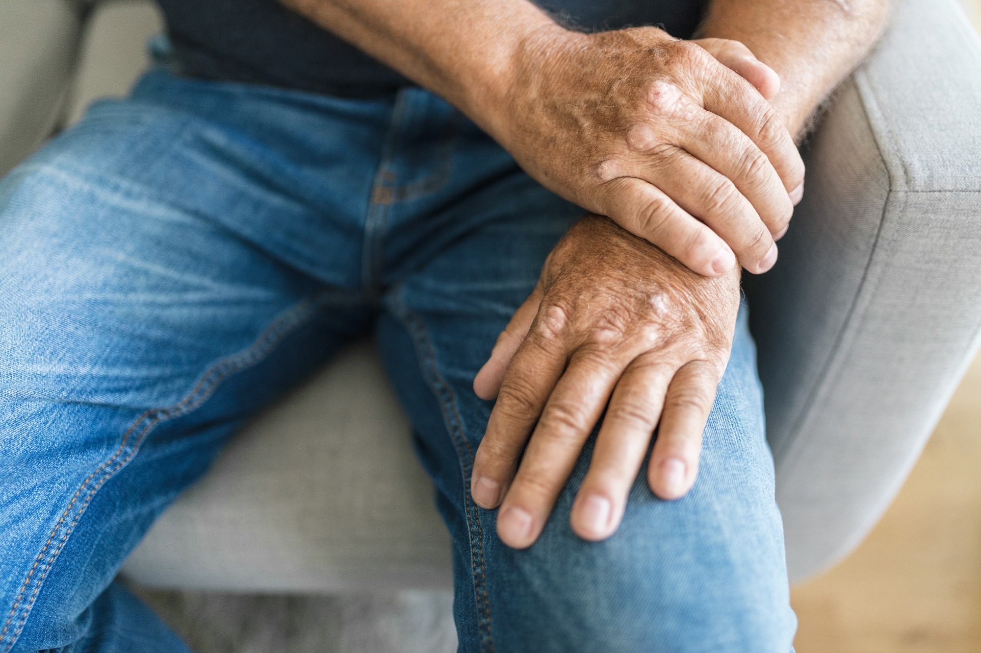 Study: DNA methylation patterns in CD4+ T-cells separate psoriasis patients from healthy controls, and skin psoriasis from psoriatic arthritis. Image Credit: And-One / Shutterstock