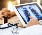 AI model accurately forecasts patient outcomes for common lung cancer after surgery