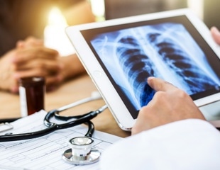 AI model accurately forecasts patient outcomes for common lung cancer after surgery