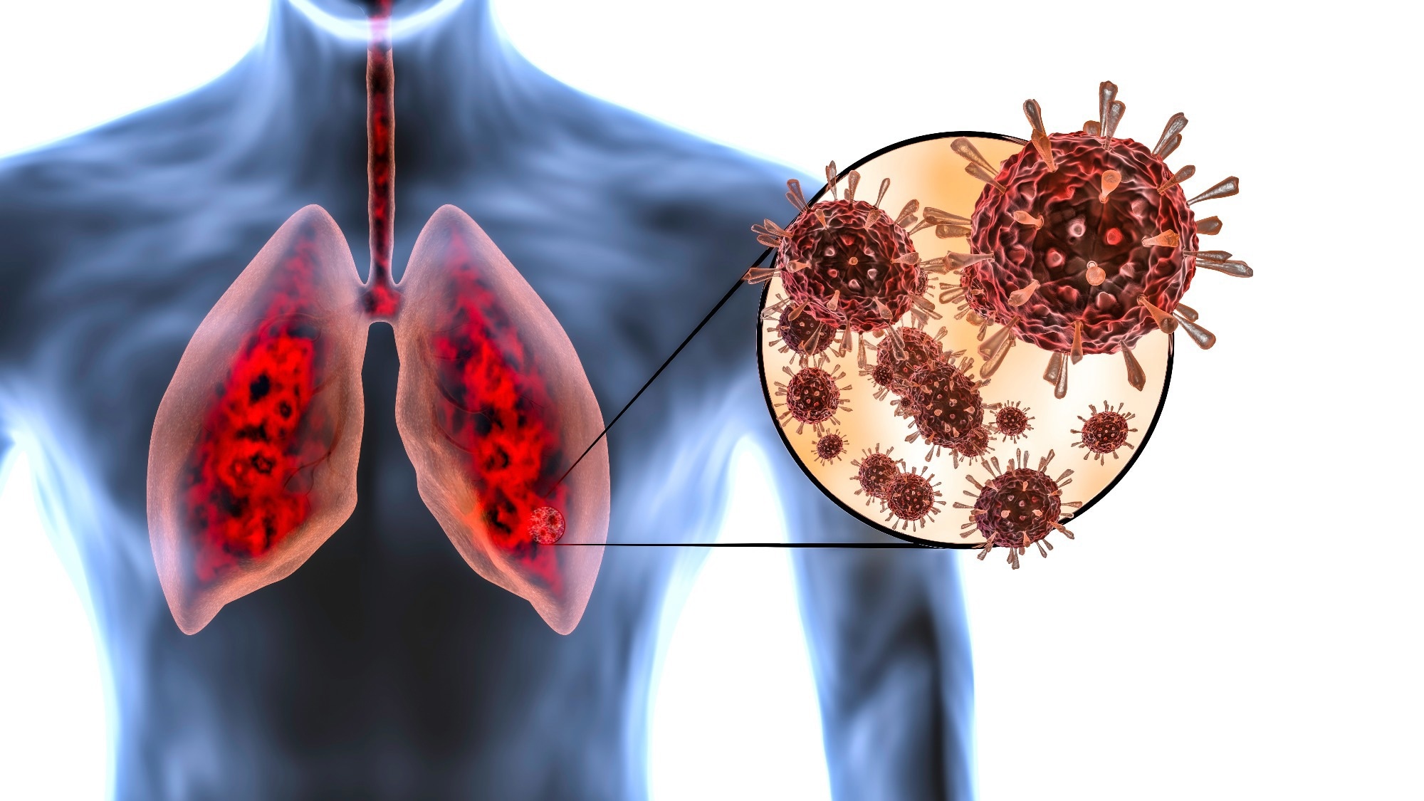 Study: Genetically determined thymic function affects strength and duration of immune response in COVID patients with pneumonia. ​​​​​​​Image Credit: MarcinWojc / Shutterstock
