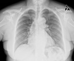 Can AI outperform radiologists in detecting lung issues? New study weighs in