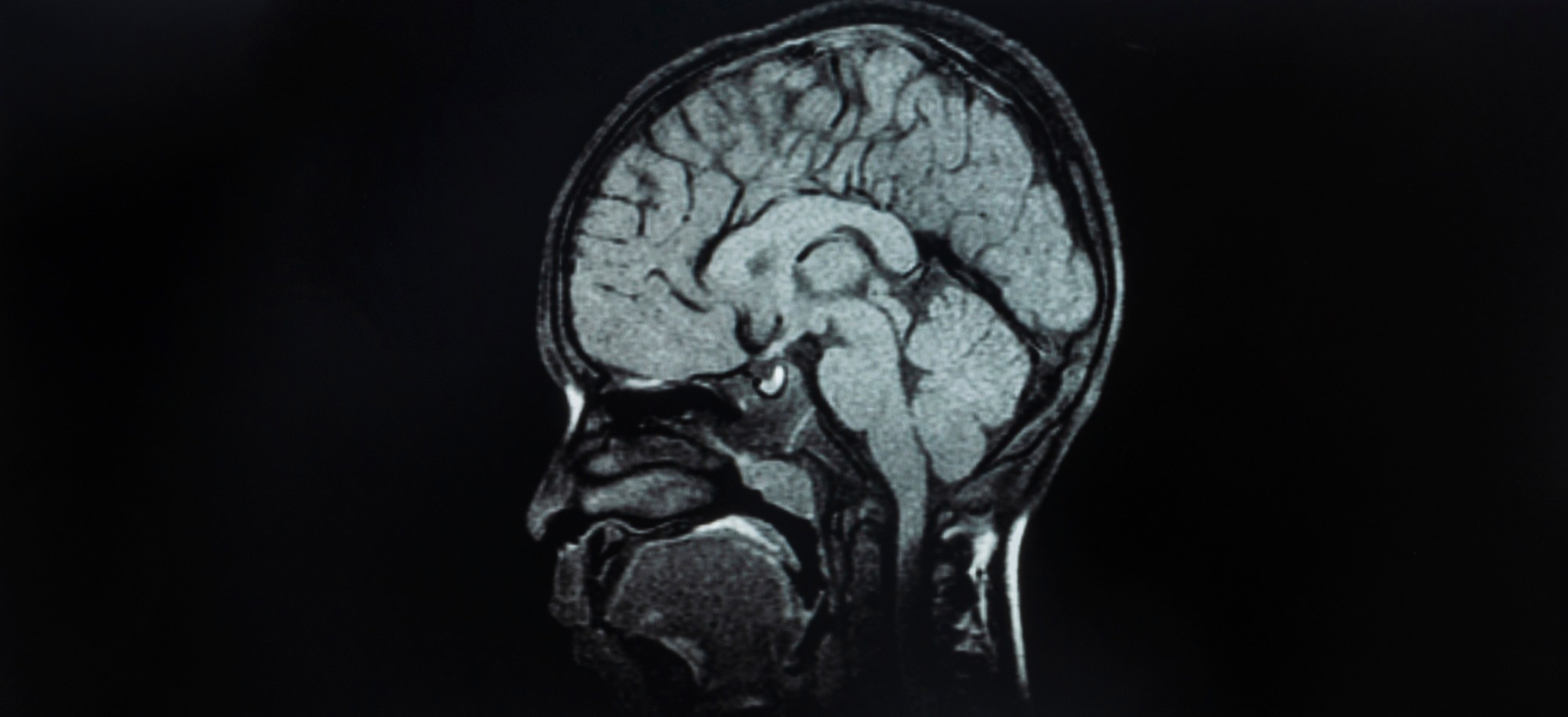 Integration of 3D-printed cerebral cortical tissue into an ex vivo lesioned brain slice