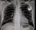 Is generative AI the future of rapid and accurate chest radiograph interpretation in the ER?