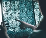 Advanced neuroimaging reveals surprising link between glaucoma and Alzheimer's disease