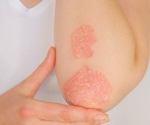 Is there an association between psoriasis onset and risk of autoimmune disease?