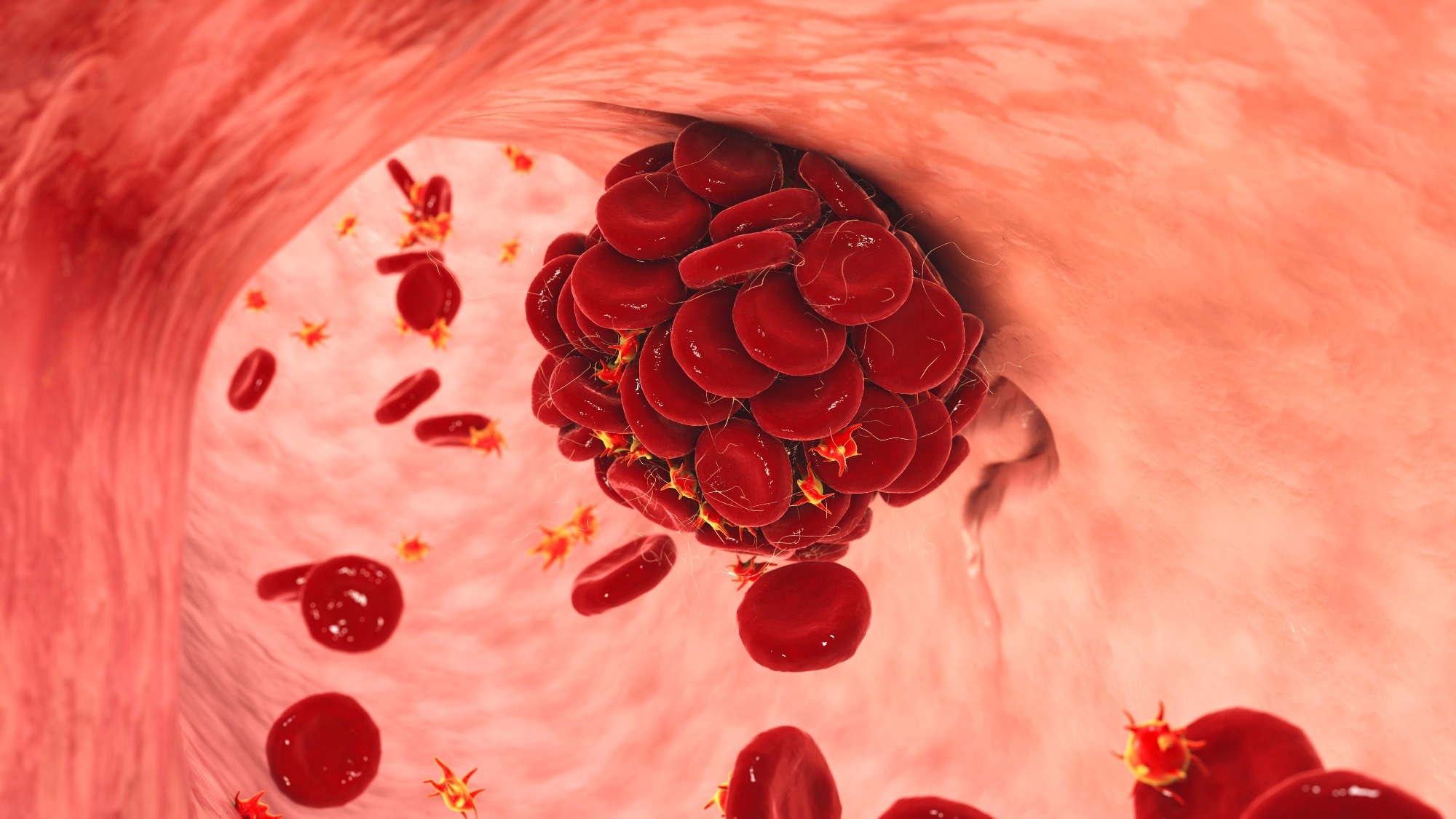 Study: Venous Thromboembolism After COVID-19 Infection Among People With and Without Immune-Mediated Inflammatory Diseases. Image Credit: Kateryna Kon / Shutterstock