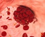 Inflammatory diseases don't boost clotting risks post-COVID, study reveals