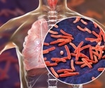 Fighting tuberculosis: Breakthrough analysis reveals mixed strain infections
