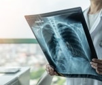 Long-term lung issues and lower quality of life plague COVID-19 survivors, new study warns